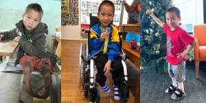 7 Tahun Hanya Bisa Merangkak, Anak Ini Akhirnya Mampu Berjalan