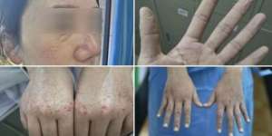 Tangani Virus Corona Wuhan, Tubuh Perawat Penuh Bercak Merah