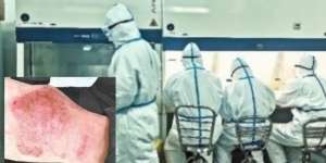 Kerja 12 Jam di Lab Temukan Obat Virus Corona, Tangan Dokter Merah dan Bengkak