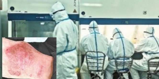 Kerja 12 Jam di Lab Temukan Obat Virus Corona, Tangan Dokter Merah dan Bengkak