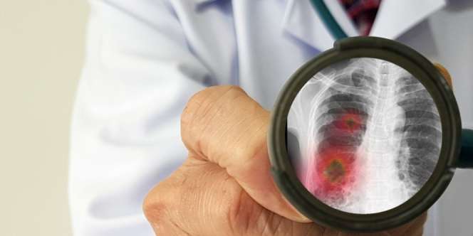 Mengejutkan! Virus Corona Tetap Hidup di Paru-paru Korban yang Meninggal