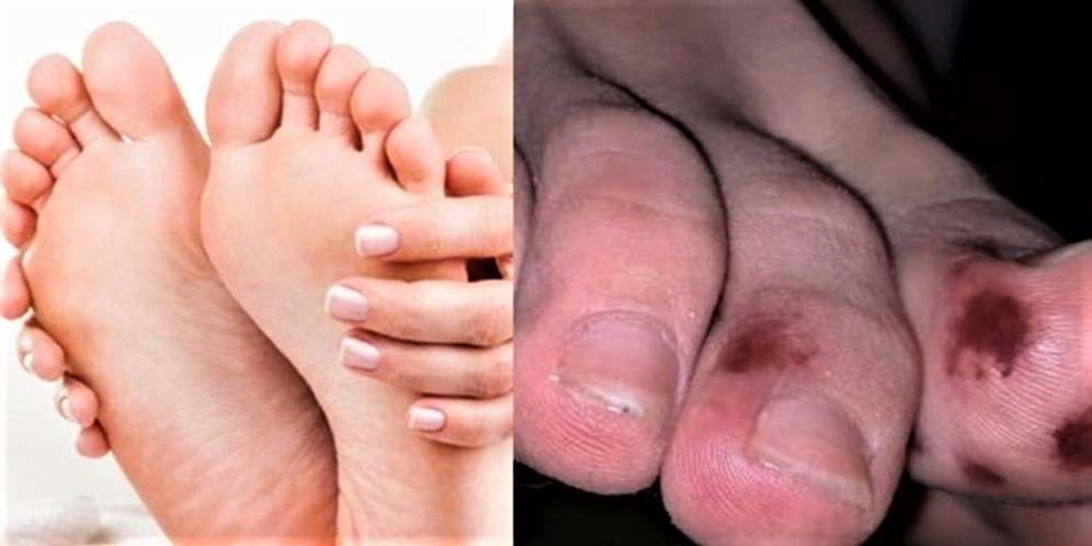 Memar di Kaki Bisa Jadi Gejala Covid-19
