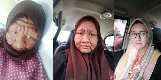 Ibu Hamil Alami Hal Aneh, Wajah Bengkak & Keriput Mirip Nenek