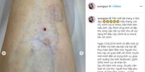 Usai Suntik Botox, Selebgram Alami Kerusakan Otot