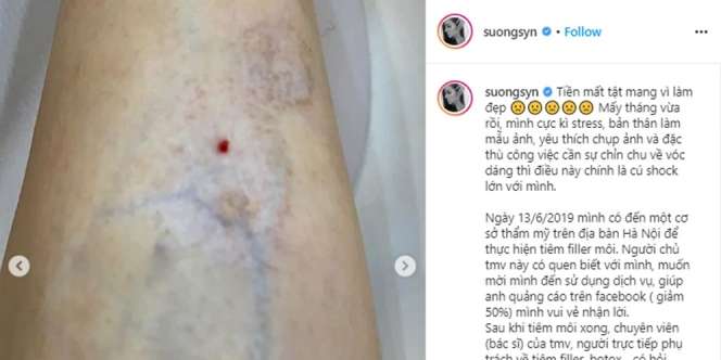 Usai Suntik Botox, Selebgram Alami Kerusakan Otot