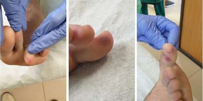 Viral Luka Mirip Cacar atau Campak di Kaki Gejala Baru Covid-19, Ini Kata Ahli