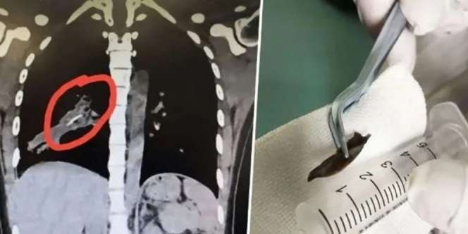 Batuk 14 Tahun Tak Sembuh, Usai Dicek Ada Tulang Ayam Nyangkut di Paru-Paru