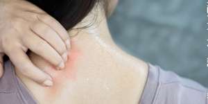 Penyebab dan Tips Mencegah Jerawat Punggung