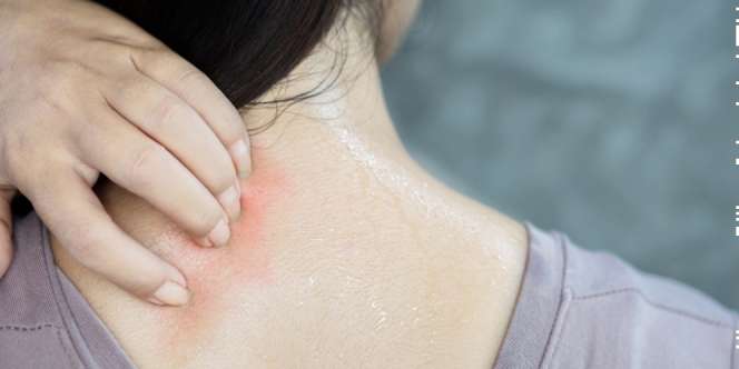 Penyebab dan Tips Mencegah Jerawat Punggung