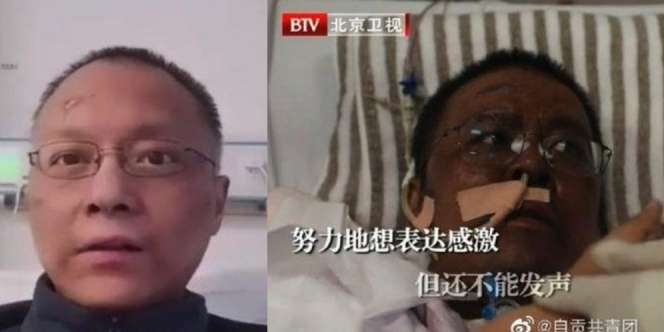 Dokter di Wuhan yang Kulitnya Jadi Hitam karena Covid-19 Meninggal Dunia