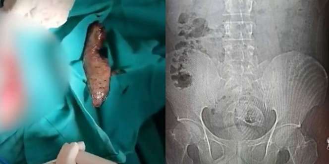 Heboh Ikan Nila Masuk Bokong, Dokter Kebingungan