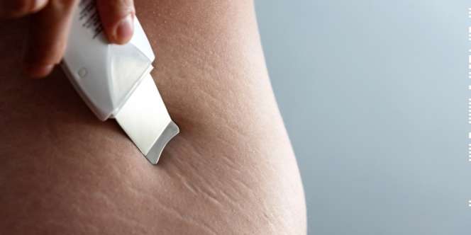 2 Campuran Minyak Alami Samarkan Stretch Marks
