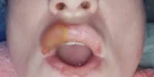 Over Dosis Filler, Bibir Mamah Muda Ini Meledak Lima Kali
