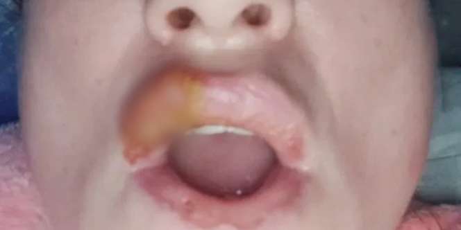 Over Dosis Filler, Bibir Mamah Muda Ini Meledak Lima Kali