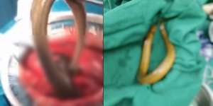 Masukkan Belut Hidup 40 Cm Buat Obati Sembelit, Usus Pria Ini Bolong