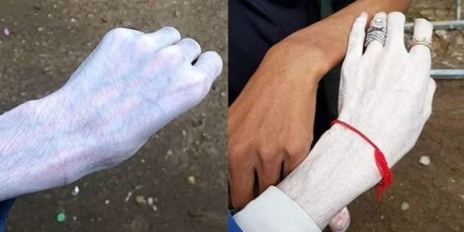 Geger Krim Pemutih Kulit, Efeknya Malah Bikin Merinding!