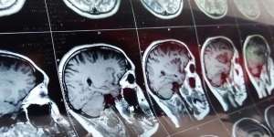 Pasien Covid-19 yang Sembuh Dihantui Penyakit Mengerikan Ini