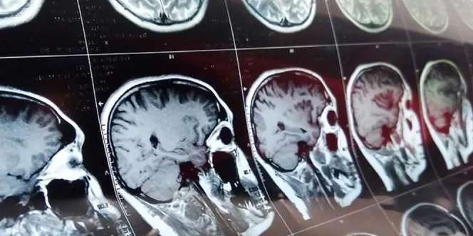Pasien Covid-19 yang Sembuh Dihantui Penyakit Mengerikan Ini