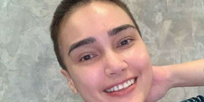 Terungkap! Ini Penyakit yang Bikin Kepala Feby Febiola Botak