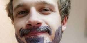 Nahas! Wajah Pria Ini Terbakar Usai Menyemir Jenggot dan Kumis