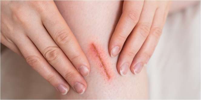 13 Rekomendasi Obat Pengering Luka dengan Cepat dan Efektif