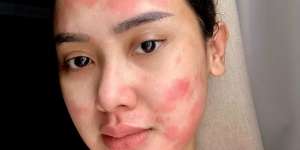 Streptococcus Tonsilitis Bikin Cita Citata Harus Dioperasi, Kenali Gejalanya