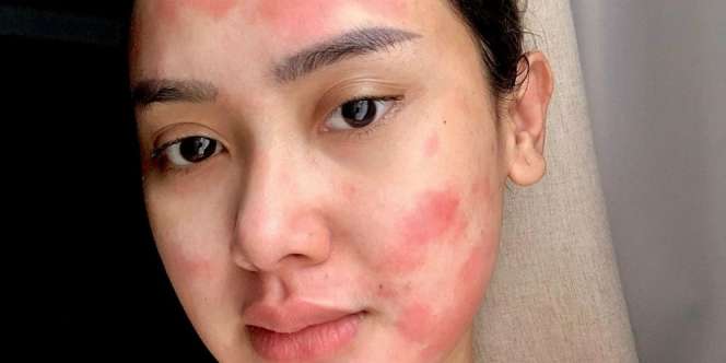 Streptococcus Tonsilitis Bikin Cita Citata Harus Dioperasi, Kenali Gejalanya