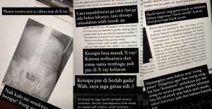 Heboh Wanita Pasang Ratusan Susuk, Terlihat Jelas Saat Foto X-ray