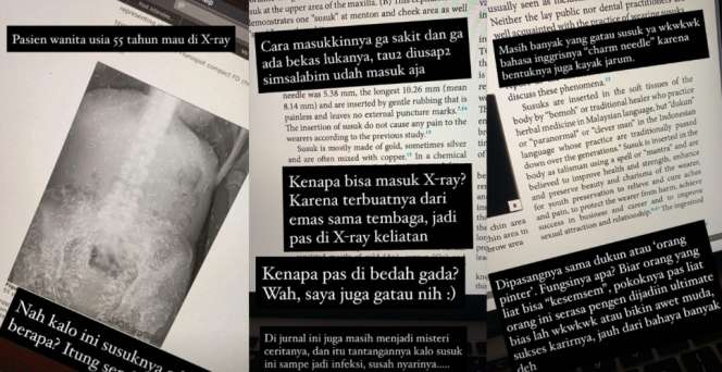 Heboh Wanita Pasang Ratusan Susuk, Terlihat Jelas Saat Foto X-ray