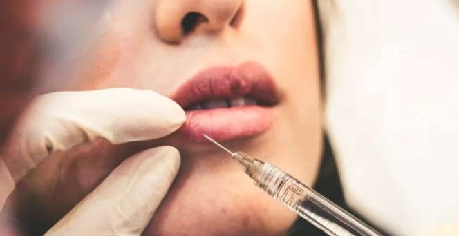 Suntik Filler Salah Prosedur, Mulut Bengkok dan Alis Mengkerut