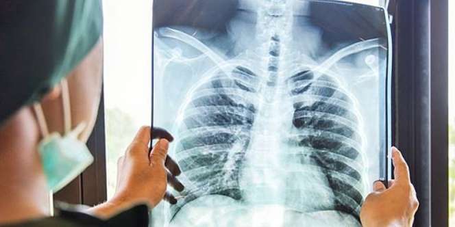 Peneliti Temukan Cairan dalam Paru-Paru Pasien Covid-19, Seperti Orang Tenggelam