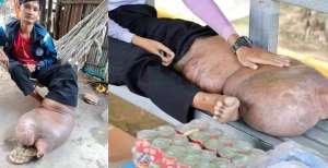 Cuma Digigit Nyamuk, Pemuda Derita Sakit Aneh dan Tak Ada Obatnya