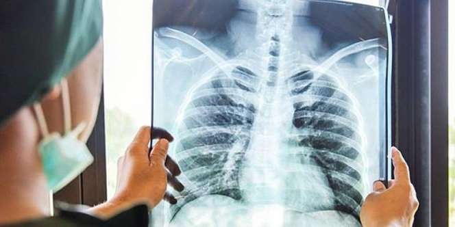 Selain Cairan, Ilmuwan Temukan Gel di Paru-Paru Pasien Covid-10 Kritis