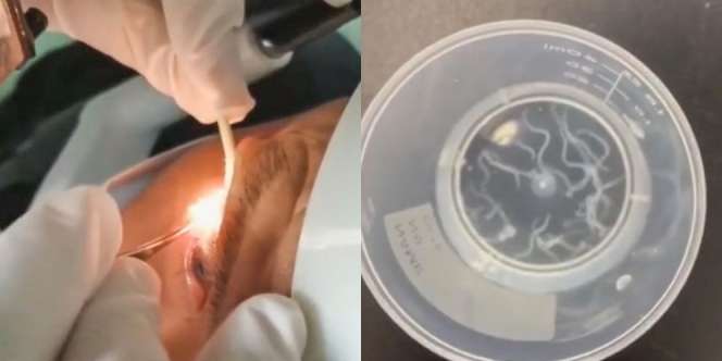20 Cacing Hidup Dikeluarkan dari Kelopak Mata Kakek