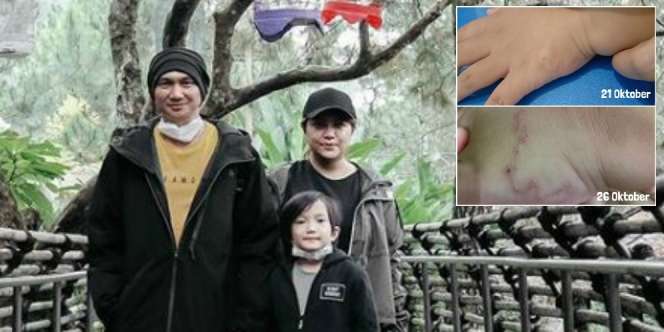 Ngeri! Telapak Tangan Anak Anji Kemasukan Cacing, Begini Penampakannya