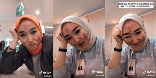 Viral Teller Bank Cantik Wajahnya Penuh Jerawat, Penyebabnya Bikin Merinding
