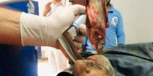 Dokter Berhasil Keluarkan Ikan Hidup dari Tenggorokan Nelayan