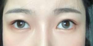 Salah Pakai Softlens, Mata Wanita ini Jadi 'Juling'