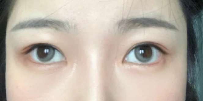 Salah Pakai Softlens, Mata Wanita ini Jadi 'Juling'