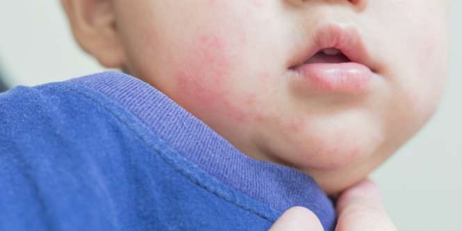 5 Hal yang Harus Diketahui Soal Ruam Anak Terkait Covid-19