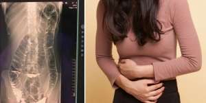Sering Alami Sembelit, Kondisi Organ Wanita Ini Bikin Ngeri