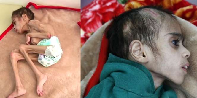 Foto Pilu Bocah Yaman Lumpuh & Kurang Gizi, Bobot 7 Kg Hanya Bisa Tergolek Lemah