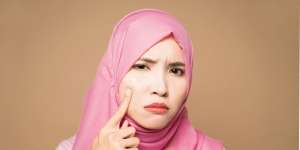 4 Perawatan Kulit yang Dapat Mengatasi Bekas Jerawat