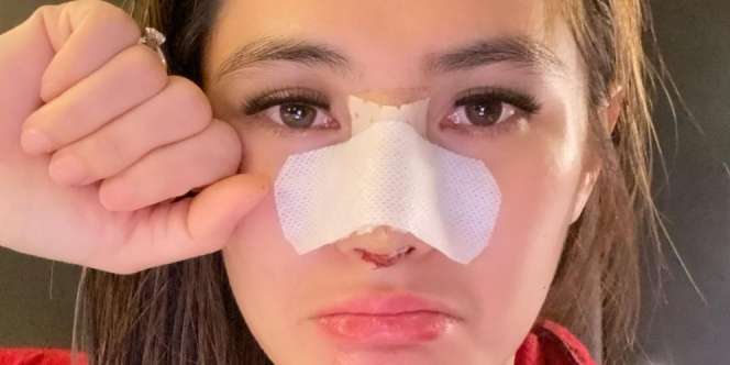 Operasi Plastik, Wajah Angela Lee Jadi Sorotan