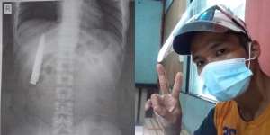 Baru Sadar, Ternyata Ada Pisau Tertanam di Dada Lebih dari Setahun