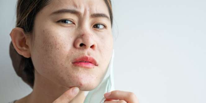 Ketahui Penyebab dan Cara Mencegah Jerawat di Dagu