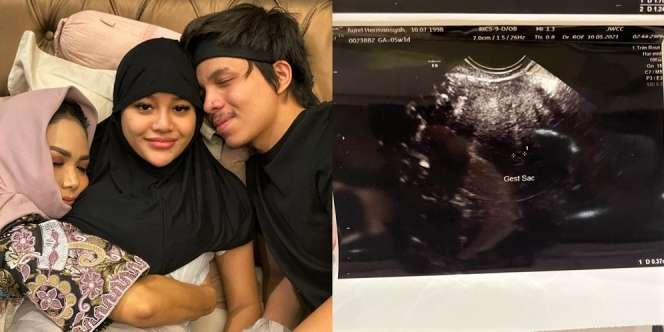 6 Fakta Aurel Alami Keguguran, Dugaan Penyebab Hingga Kronologi Kejadian