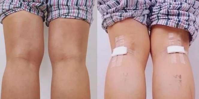 Tren Kecantikan Mengerikan, Potong Saraf Kaki Biar Betis Jadi Ramping