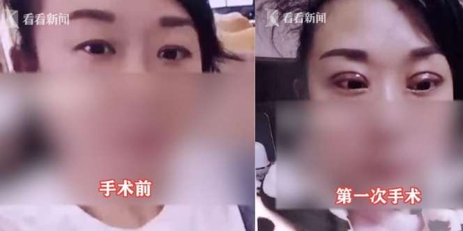 Sudah Hasil Operasi Double Eyelid Gagal, Istri Terancam Diceraikan