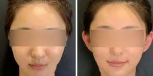 Tren Operasi 'Elf Ear' di China Dipercaya Dapat Membuat Wajah Lebih Mungil